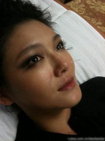 明星做针灸,针灸疗法助力健康美丽